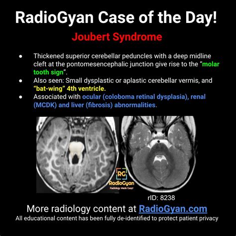 syndrome du hublot|Joubert syndrome .